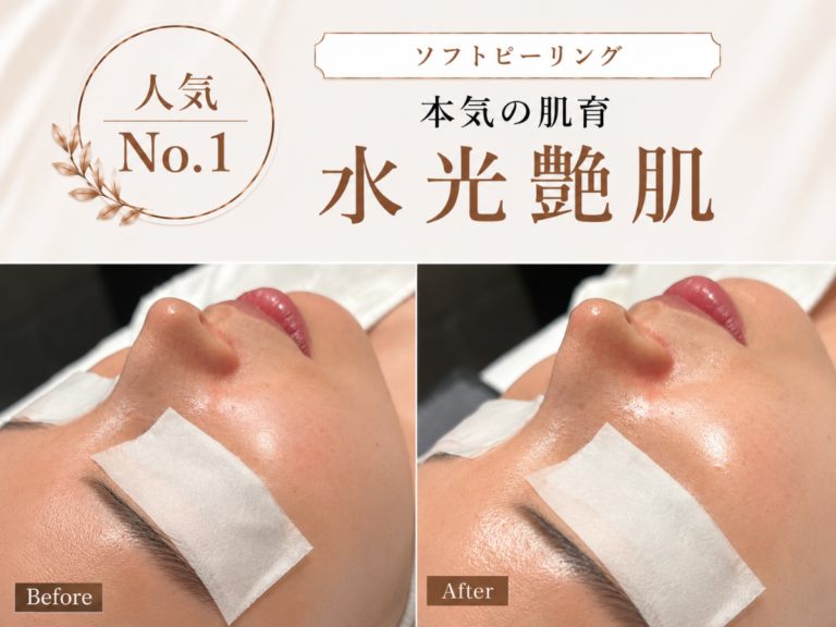 ソフトピーリングの施術イメージ
