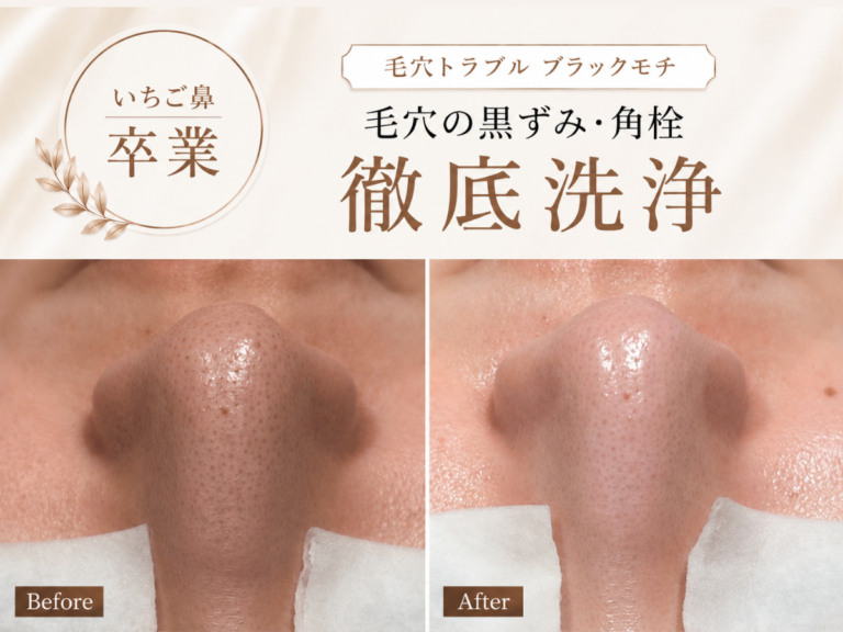 毛穴トラブルブラックモチの施術イメージ