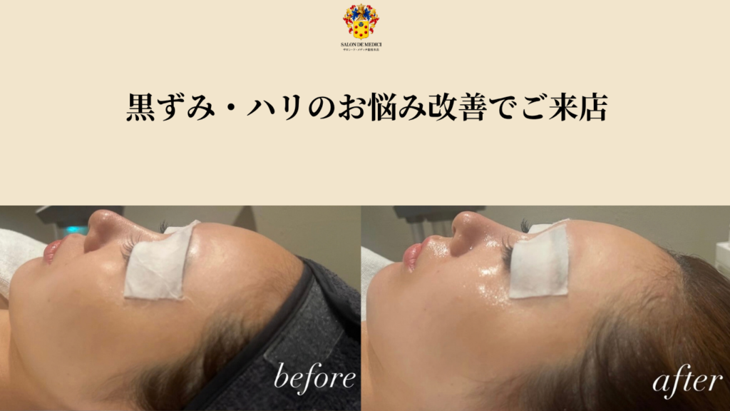 初回のお客様：りあ様 ビフォーアフター画像