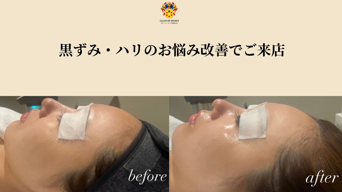 初回のお客様：りあ様 ビフォーアフター画像